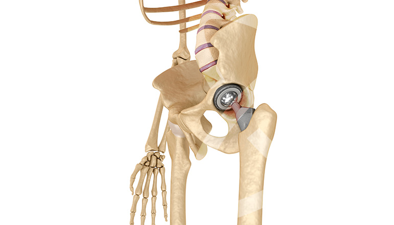 Artroplastia Imagem Artroplastia