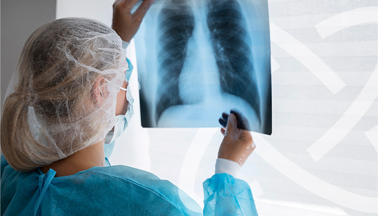 Imagem Neoplasia Pulmonar